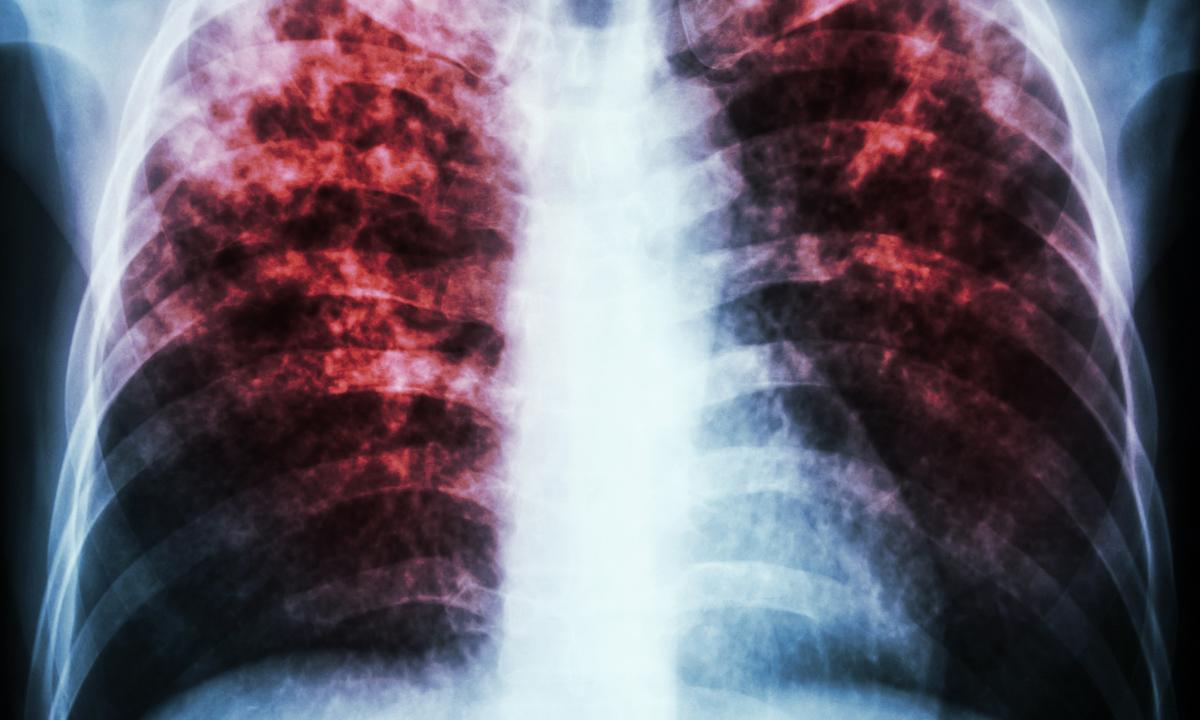 Tubercolosi disseminata: caratteristiche generali della malattia, cause dell'apparenza, sintomi e segni