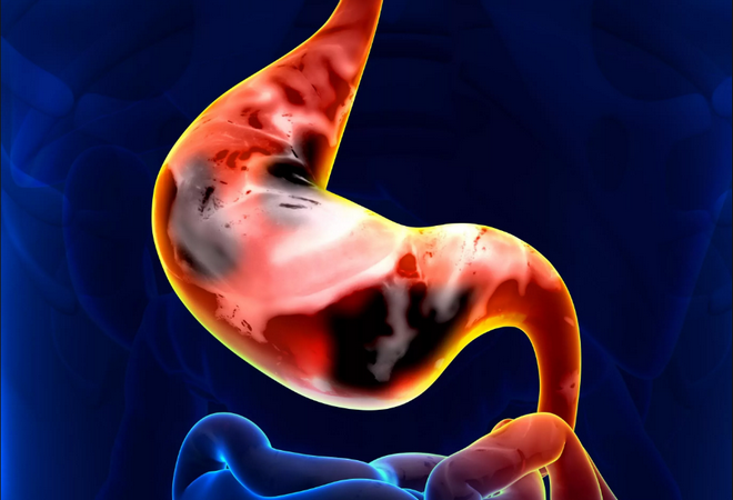Gastrite hipertrófica: o que é, crônica, o tratamento
