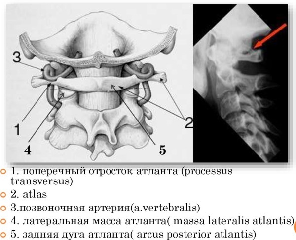 Kimmerly's anomaly in the cervical spine. Symptoms, treatment, consequences