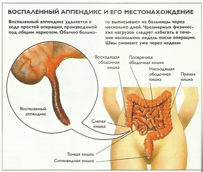 Colitis i nedre højre mave hos kvinder i nærheden af ​​bækkenbenet. Årsager under graviditeten, hvad er det