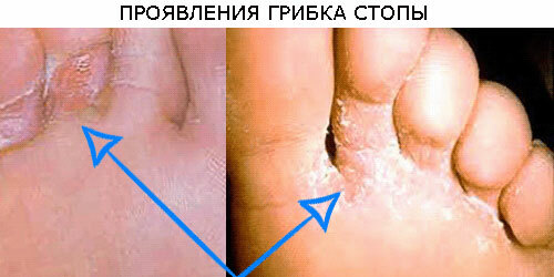 So the fungus of the foot looks like, photo
