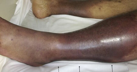 Treatment of foot thrombophlebitis