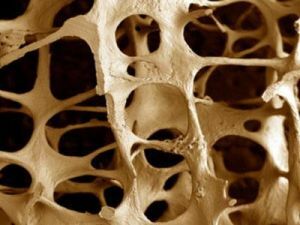 Osteoporozė