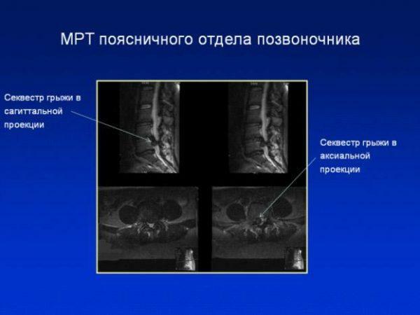MTR של שבר של עמוד השדרה המותני