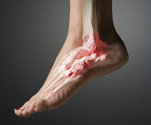 Osteoarthritis of the ankle