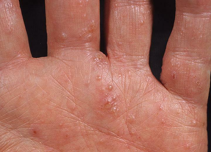A acne aquosa no corpo - causas e tratamento
