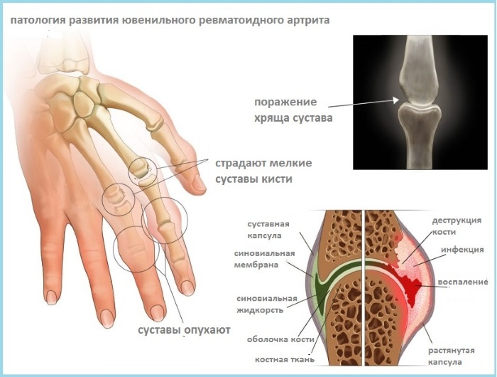 Rheumatoid arthritis. Diagnosis of blood, etiology, pathogenesis, causes, symptoms and treatment