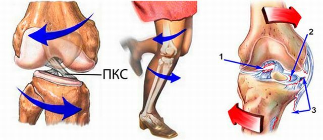 First aid in rupturing the ligaments of the knee joint