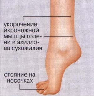 ayağın parezisinde semptomlar