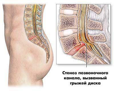 Spinal stenosis caused by disc herniation