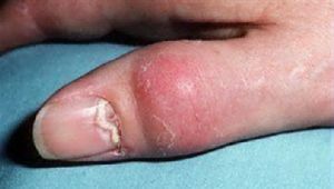 דלקת מפרקים פסוריאטית של אצבעות