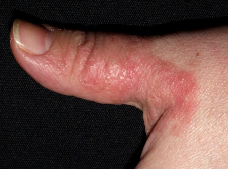 eczema en los dedos de las manos, foto