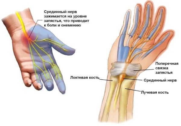 Syndrome du tunnel main du poignet du poignet. Les symptômes et le traitement des remèdes populaires, l'opération