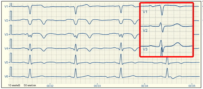 Cicatricial změny v myokardu na EKG