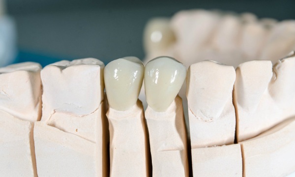 Crowns zirconia. Price, service life, manufacturers, pros and cons