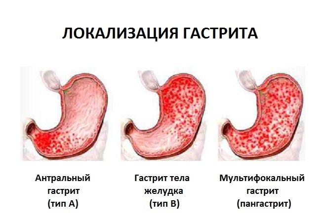 Localization gastritis