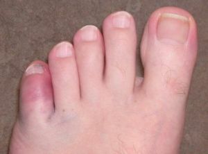 Cum să identificați și ce să faceți în cazul în care degetul mic este rupt pe picior?