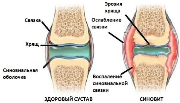Diseases of the knee joint. Symptoms, causes, treatment, classification
