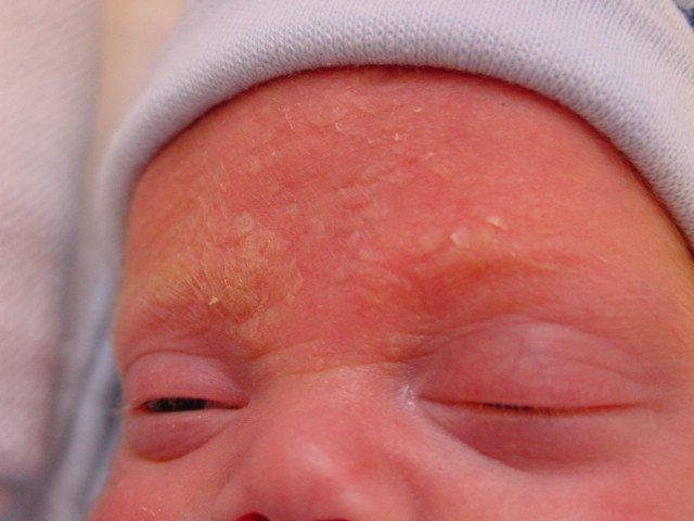Seborrhoe bei einem Neugeborenen