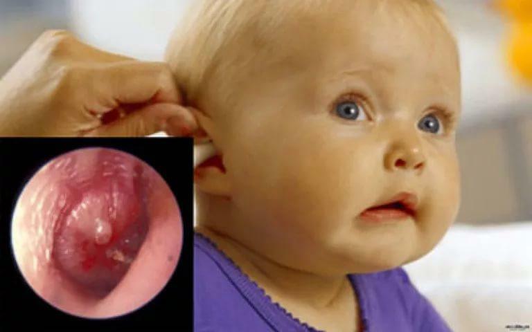 Otitis media of the middle ear in children