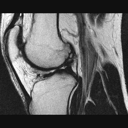 Disecția osteochondrită( stadiul bolii König) a III-a, a articulației genunchiului