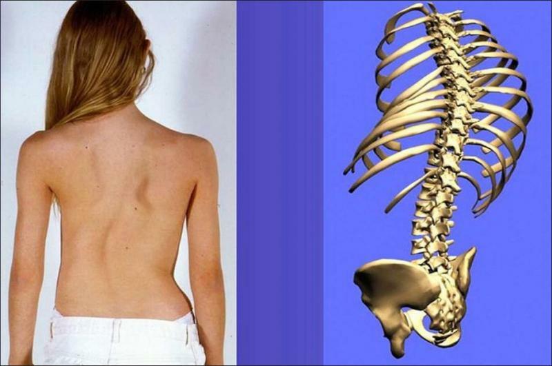 Coloana vertebrală este curbată spre dreapta