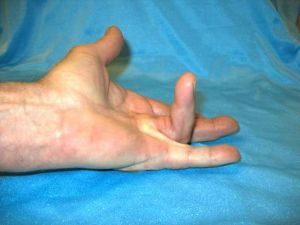 contracture of fingers