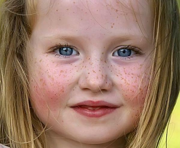 Freckles in children