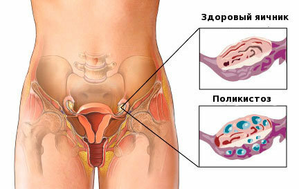 Pregnancy after removal of the ovarian cyst
