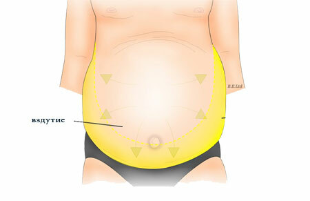 Ascite da cavidade abdominal