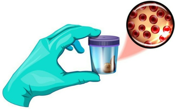 Occult blood in the stool is positive. What does this mean in an adult, a child, causes, treatment