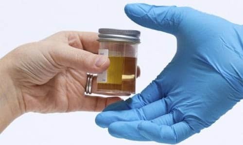 Over wat erytrocyten spreken in de samenstelling van mannelijke urine