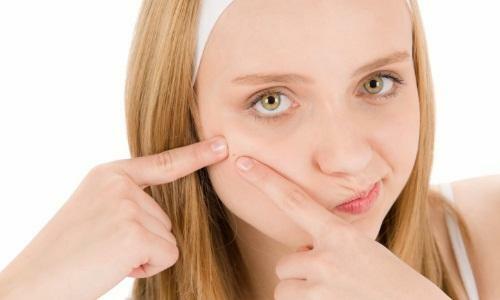 Teenage pimples i jenter: behandling og forebygging