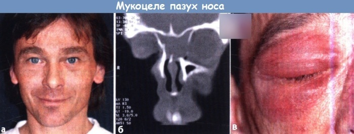 Mucocele av maxillary sinus. Hva er det, tegn, CT, MR, behandling, kirurgi