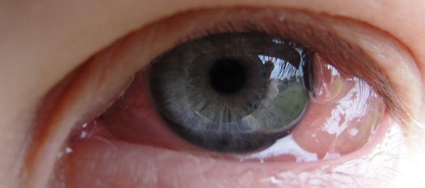 Levofloxacin (Levofloxacin) øjendråber. Pris, brugsanvisning, analoger