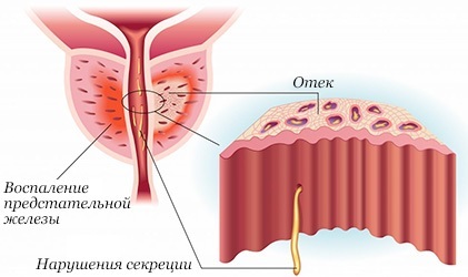 Prostatito žvakutės yra veiksmingos priešuždegiminės, profilaktikai: Diklofenakas, Vitaprostas, Ichtiolis