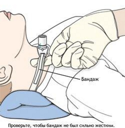Ивл трахеостомическая трубка. Трахеостома санирование. Трахеостома санация алгоритм. Санирование трахеостомической трубки алгоритм. Трубка для санации трахеостомы.