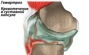 Hemarthroza kolenního kloubu: příznaky a léčba