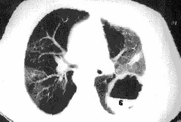 Diagnostic examination of the lung