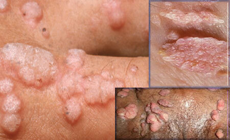 Simptomi ljudskog papiloma virusa kod žena