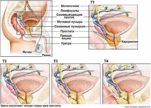 Stadier af prostatakræft
