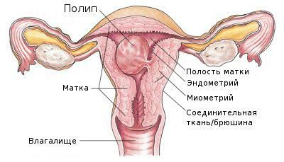 Polipose endometrial