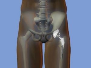 osteonekrose af hofteleddet