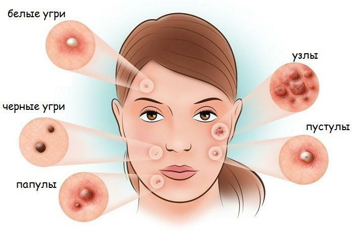 El remedio más efectivo para el acné en la cara