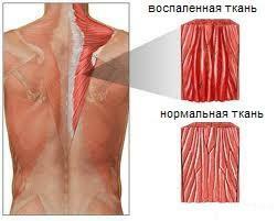 Miositis de los músculos de la espalda - esquema