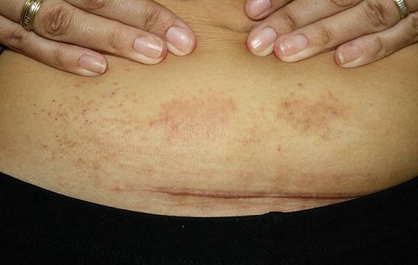 Allergisk dermatitt