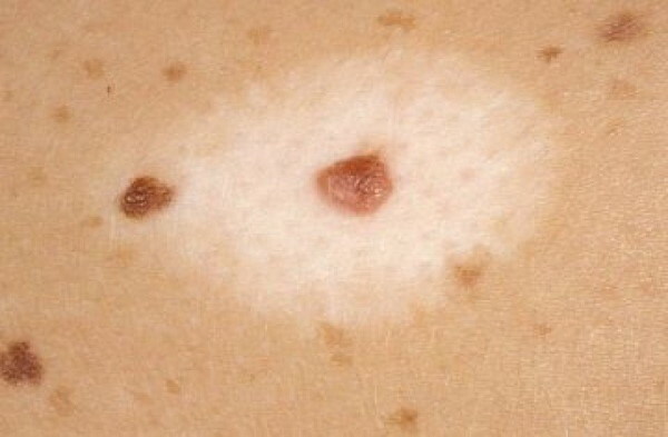 Types of moles on the body, face. Photos with a description, dangerous or not