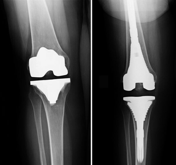 Artroplastika koljena. Cijena, sanacija