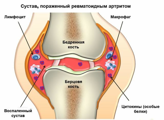 Se as articulações derrubaram a artrite reumatóide: sintomas e tratamento