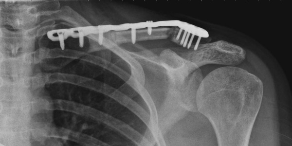 Fracture of the clavicle. Treatment at home, terms of rehabilitation